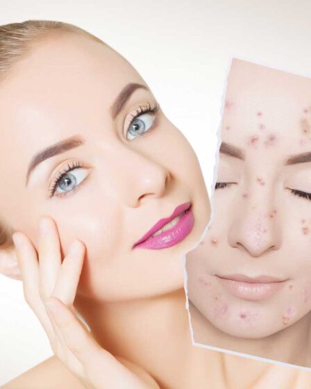 Laser Lavieen: conheça o melhor tratamento facial para 2025!