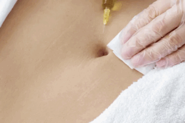 Intradermoterapia estética, revitalização e estímulo profundo da pele