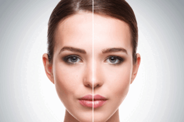Laser Lavieen: para que serve, resultados, antes e depois e quando vale a pena