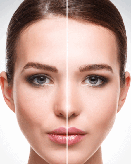 Laser Lavieen: para que serve, resultados, antes e depois e quando vale a pena