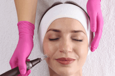 Microagulhamento: o tratamento que estimula colágeno, renova a pele e transforma sua aparência