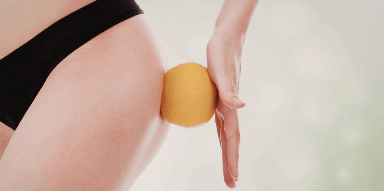 Celulite: 10 dicas infalíveis para reduzir o aspecto de “casca de laranja”