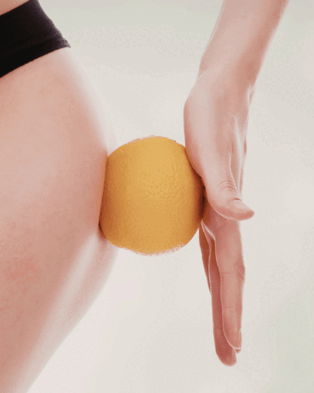 Celulite: 10 dicas infalíveis para reduzir o aspecto de “casca de laranja”