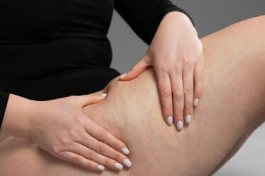 Celulite ou gordura localizada: como diferenciar?